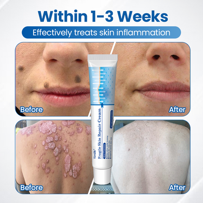 Timilk® Fragile Skin Repair Cream🔥