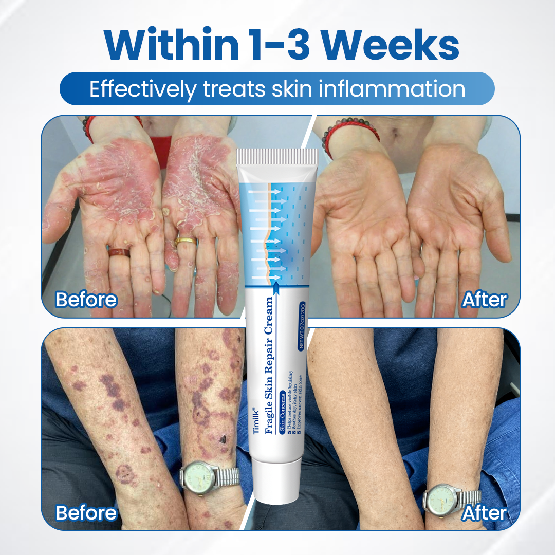 Timilk® Fragile Skin Repair Cream🔥